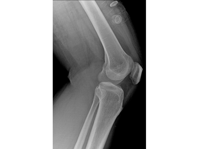 X-Ray Image of Knee